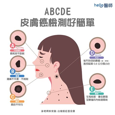 痣變大變凸|痣變大、痣形狀奇怪可能是皮膚癌先兆？皮膚科醫生最全面的痣資訊